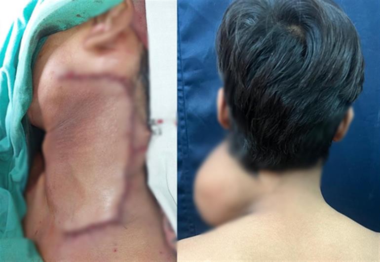 BMC hospital removes 2.5 kg tumour from teen's neck after 7 hr surgery