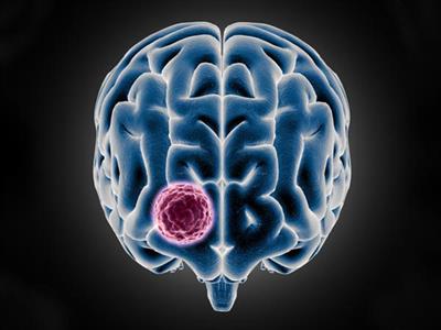 Lifestyle choices increase risk of developing brain tumours: Experts