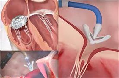 Doctors treat woman’s heart disease using minimally invasive transcatheter clips