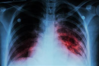 Study shows who should take preventive treatment for TB