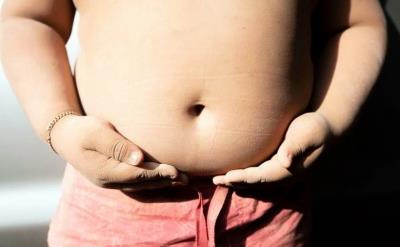 Children with severe obesity at age 4 may have a life expectancy of just 39: Study