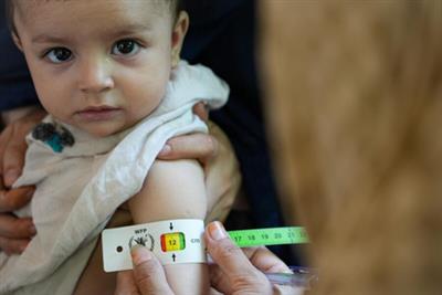WFP warns of malnutrition threats in Afghanistan, 3.5 million children at risk in 2025
