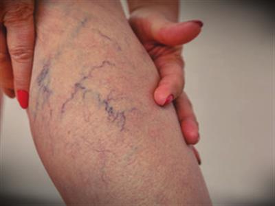 Ice-cold feet and heaviness in legs? It may signal varicose veins, says study