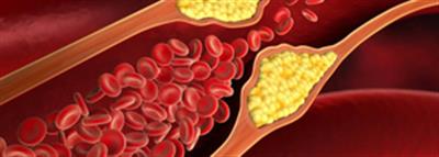 Indian scientists develop optical sensing platform to detect cholesterol