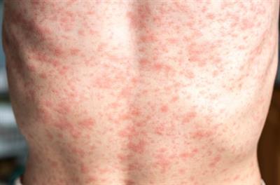 US faces resurgence of measles cases as vaccination rates decline: Study