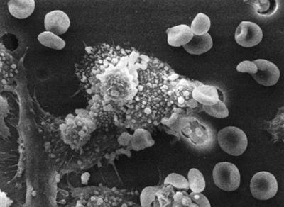 Study decodes how malaria can lead to childhood cancer