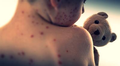 US reports over 800 measles cases in 2025