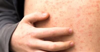Texas outbreak could upend measles elimination claim by US
