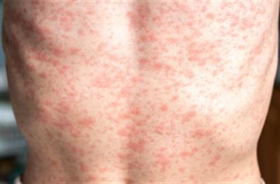 2025 में अब तक अमेरिका में खसरे के 900 से ज़्यादा मामले सामने आए: CDC