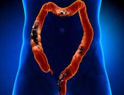Gene-editing therapy shows promise against advanced colorectal cancer