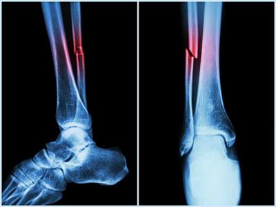 NIT Rourkela study to boost bone regeneration technology