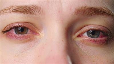 ਸ਼ਹਿਰ ਦੇ ਡਾਕਟਰਾਂ ਨੇ ਅੱਖਾਂ ਦੀਆਂ ਸਮੱਸਿਆਵਾਂ ਵਿੱਚ 50 ਪ੍ਰਤੀਸ਼ਤ ਵਾਧਾ ਦਰਜ ਕੀਤਾ ਹੈ ਕਿਉਂਕਿ ਧੂੰਆਂ ਦਿੱਲੀ ਨੂੰ ਆਪਣੀ ਲਪੇਟ ਵਿੱਚ ਲੈ ਰਿਹਾ ਹੈ